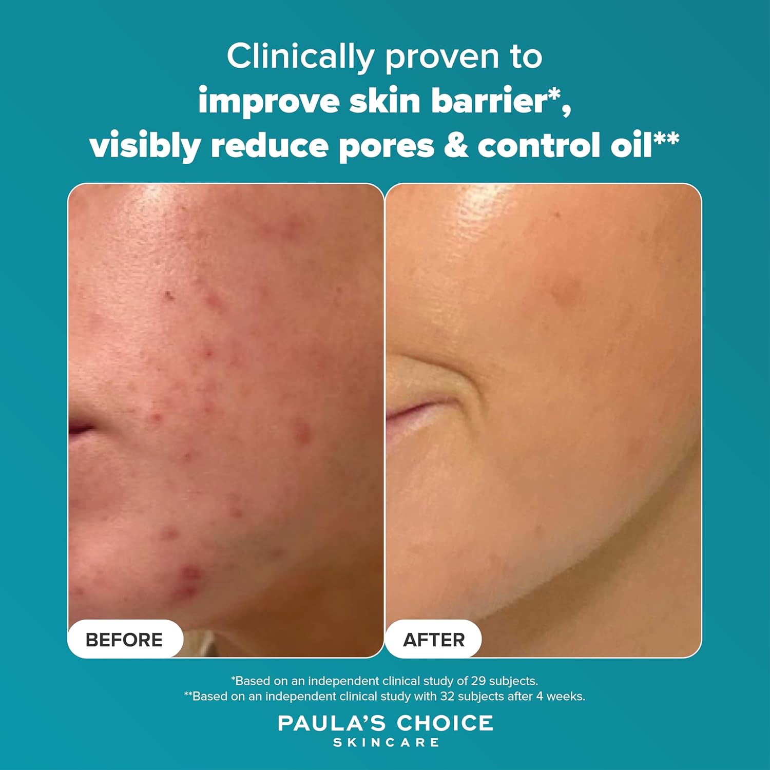 Paula's Choice SKIN PERFECTING 2% BHA Liquid Exfoliant - Face Exfoliating Peel Fights Blackheads & Enlarged Pores - with Salicylic Acid - Combination & Oily Skin - 118 ml
